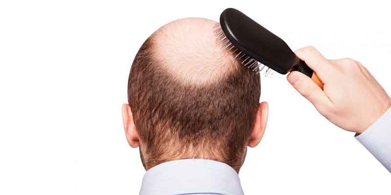 Cómo se puede disimular la alopecia Trucos para hombres y mujeres